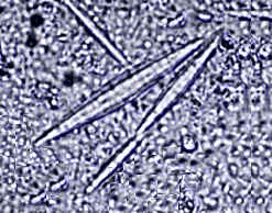 des cristaux de charcot leyden